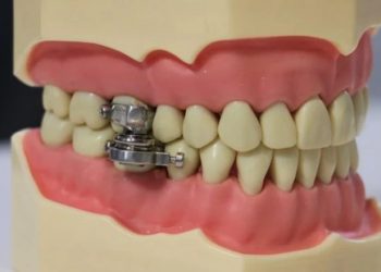 ახალი მოწყობილობა შექმნეს, რომელიც პირის გაღებას აფერხებს – ნახეთ რისთვის გამოიყენება