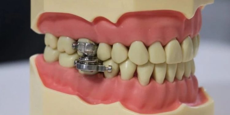 ახალი მოწყობილობა შექმნეს, რომელიც პირის გაღებას აფერხებს – ნახეთ რისთვის გამოიყენება