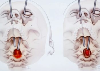 უნიკალური ოპერაცია – ექიმებმა პაციენტს ხერხემლის სიმსივნე თვალის გავლით ამოკვეთეს
