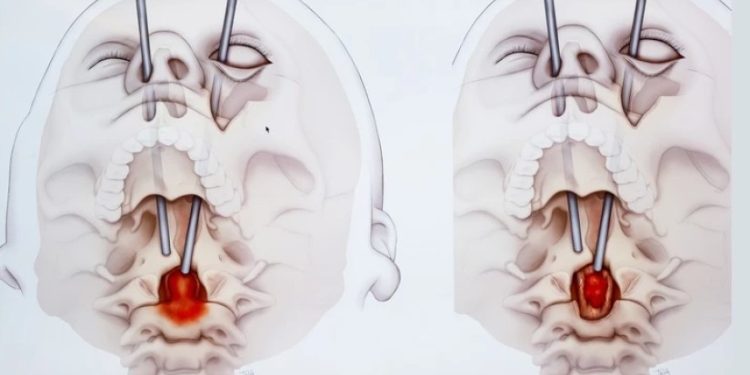 უნიკალური ოპერაცია – ექიმებმა პაციენტს ხერხემლის სიმსივნე თვალის გავლით ამოკვეთეს