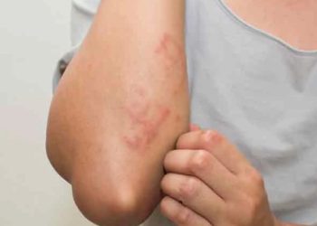 გადადის თუ არა მუნი ხელის ჩამორთმევით ან ჩახუტებით? – პასუხები ხშირად დასმულ კითხვებზე